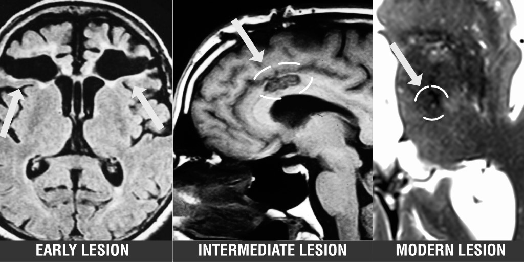 Historically, lesions were fundamental to localizing and treating neurological symptoms, but their use decreased over time. Joutsa et al. argue that improvements in technology mean that lesions may be making a comeback in the treatment of brain disease. bit.ly/3odNVMz