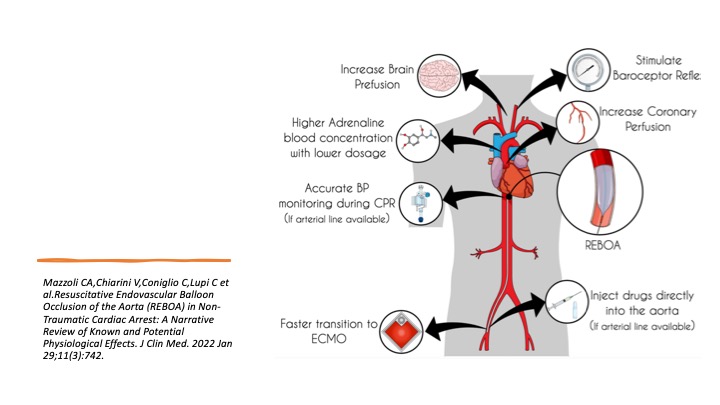 FOAMecmo's tweet image. #REBOA in trauma
🎈promising resuscitative tech for selected pts
🎈HALO High Acuity Low Occurrence procedure: decision making, training, governance, case review, debriefing pivotal
🎈better/similar survival vs thoracotomy if postinjury Ao occlusion required
@carenzmd #ParisRescue