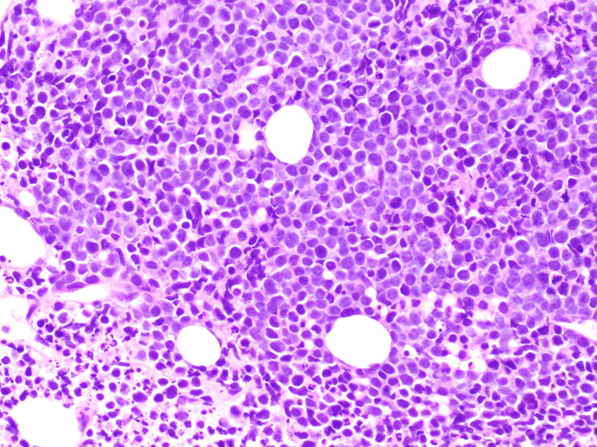 #HemPath #SurgPath 

Nasty looking tumour - large soft tissue mass and leukaemic stage