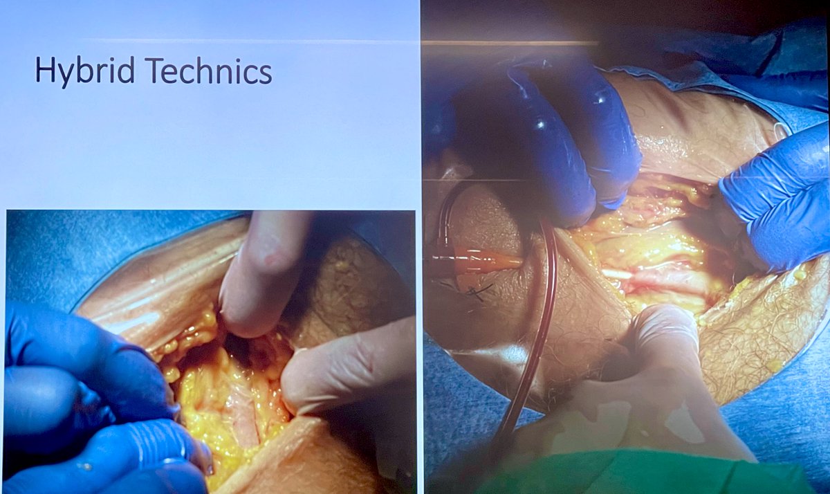 FOAMecmo's tweet photo. 🫀 #REBOA in OHCA? In zone 1 may ⬆️ brain/cardiac perfusion, occluding aorta
🎈1st line to ⬆️ P vs epinephrine?
🎈between 1st/2nd line to extend window allowing to tranfer pt to #ECMO center?
training/in-vivo research pivotal
@LionelLamhaut #ParisRescue
📖 https://t.co/JRvcVF9PWC https://t.co/wC5zbn3qTO