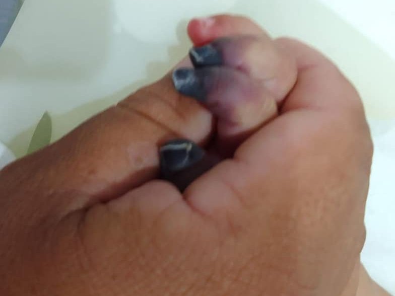 wilianDominguez's tweet photo. Amputarán 4 deditos a una bebé de 8 meses por presunta negligencia médica. 

▪️Los padres llevaron a la niña 3 veces al Hospital de Hernandarias donde 1ro le diagnosticaron dolor de oído, luego Chikunguña y posteriormente dengue.
▪️En las 3 oportunidades fueron enviados a la casa con una receta médica.
▪️Finalmente se supo que tenía neumonía bilateral avanzada que ocasionó una pérdida de circulación sanguínea del brazo derecho sufriendo una necrosis. 
▪️Del INERAM fue llevada al Hospital de Clínicas.