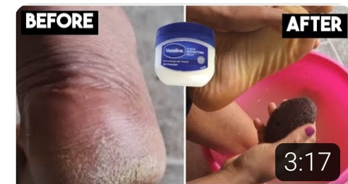 IphyKitchen's tweet image. How to Get Rid of Cracked Heel &amp;amp; Dry Feet Overnight - Get Beautiful and Smooth Feet. learn how to use toothpaste to treat and get rid of dry feet, and cracked heels at home overnight with a toothpaste mask.  #getridofcrackedheels #toothpastehacks  #footcare #vaseline