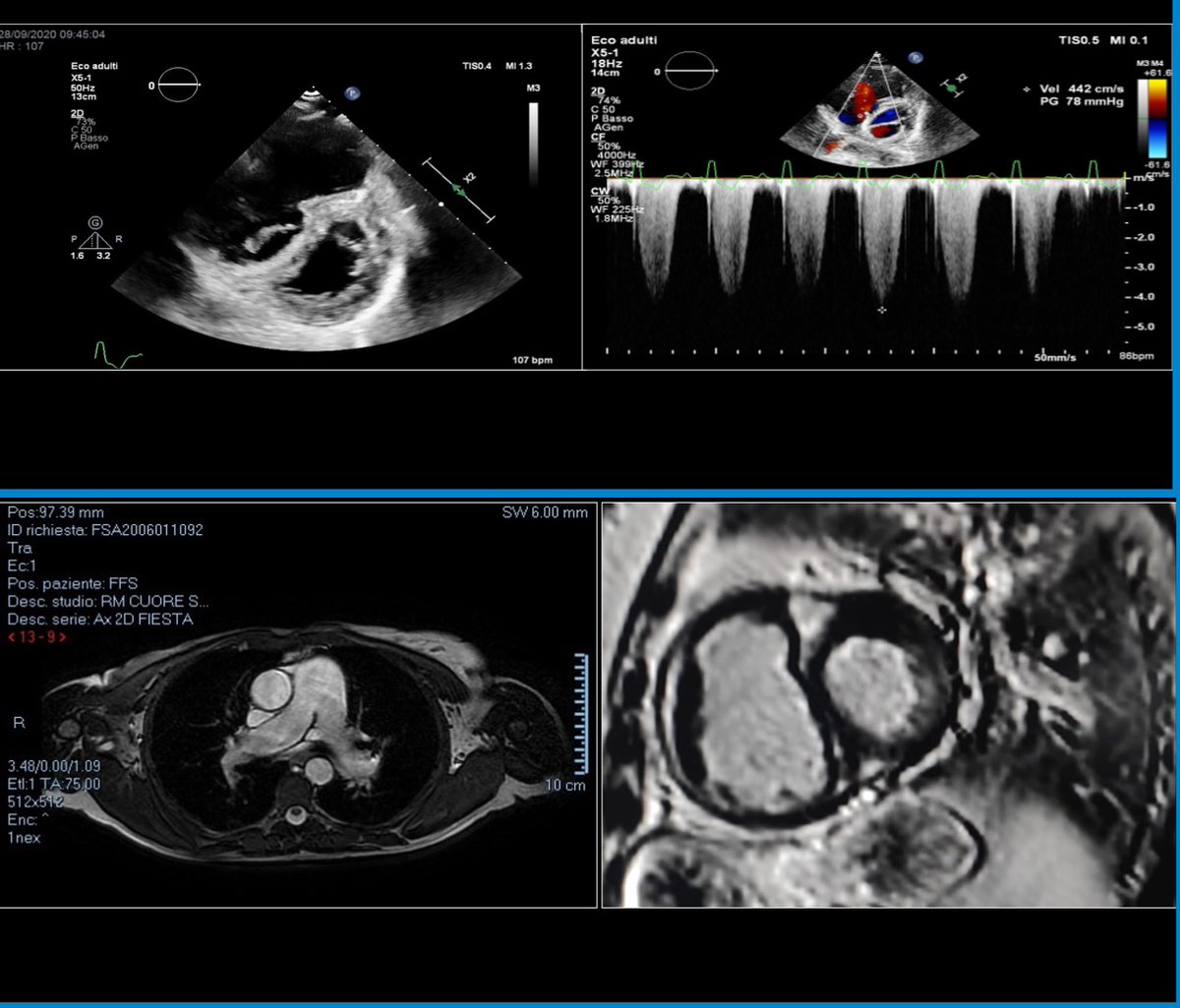 Disponibile online only un nuovo caso clinico da poter consultare. Questa volta si parla di #imaging multimodale nella sclerosi sistemica, by Lapolla, Tonet &amp; Campo.
#echofirst
#whyCMR
giornaledicardiologia.it/archivio/4004/…