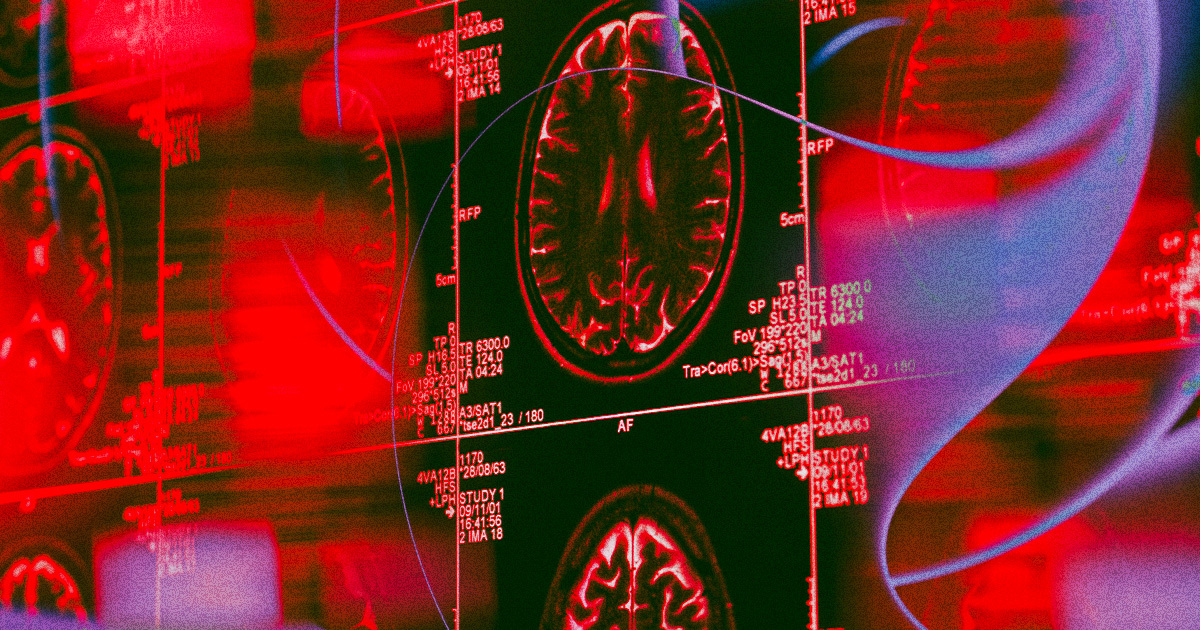 High Blood Pressure May Cause Dementia, Dave Warner says futurism.com/neoscope/high-…