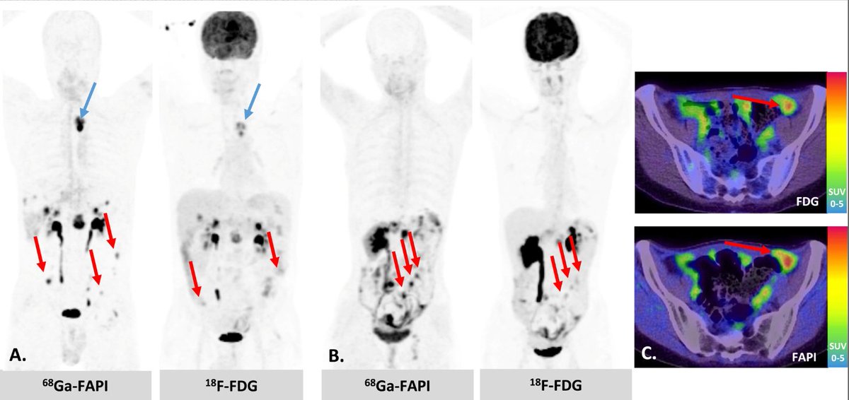 The practice of radiotheranostics brings closer the day when patients with metastatic cancer and expressing appropriate targets can have significant palliation, improved survival, or even cure.

🔗 acsjournals.onlinelibrary.wiley.com/doi/10.3322/ca…

#CancerControlMonth
#AACR23