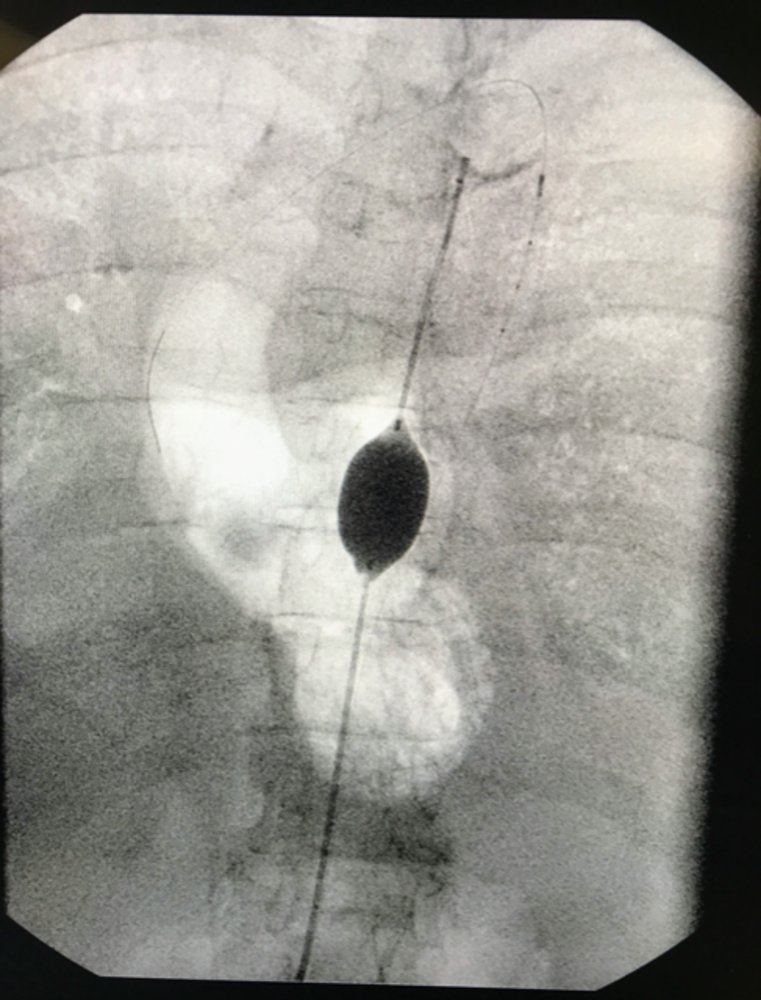 Paul Rees (@drpaulrees) on Twitter photo <a href="/Pipes_n_pumps/">Chris Bishop</a> <a href="/EMDocJB/">Jon Barratt</a> <a href="/FOAMecmo/">M Velia Antonini</a> <a href="/carenzmd/">Luca Carenzo</a> <a href="/LionelLamhaut/">Lamhaut</a> <a href="/alice_hutin/">Hutin Alice</a> <a href="/robbielendrum/">RobbieL</a> <a href="/ZackShinar/">Zack Shinar</a> @ResusOne <a href="/Resus_Spheres/">@Resus_SPHERES</a> @EmsvenG <a href="/carlo_coniglio/">carlo_coniglio</a> <a href="/cristianlupi1/">cristian lupi</a> <a href="/LorenzoGamberi6/">Lorenzo Gamberini</a> <a href="/MaxMarsden83/">Max Marsden</a> Or this: if you look really closely you can see a 0.014" angioplasty wire and a catheter loaded over it, superior to the aortic balloon and heading for the arch. <a href="/Pipes_n_pumps/">Chris Bishop</a> <a href="/EMDocJB/">Jon Barratt</a> <a href="/FOAMecmo/">M Velia Antonini</a> <a href="/carenzmd/">Luca Carenzo</a> <a href="/LionelLamhaut/">Lamhaut</a> <a href="/alice_hutin/">Hutin Alice</a> <a href="/robbielendrum/">RobbieL</a> <a href="/ZackShinar/">Zack Shinar</a> @ResusOne <a href="/Resus_Spheres/">@Resus_SPHERES</a> @EmsvenG <a href="/carlo_coniglio/">carlo_coniglio</a> <a href="/cristianlupi1/">cristian lupi</a> <a href="/LorenzoGamberi6/">Lorenzo Gamberini</a> <a href="/MaxMarsden83/">Max Marsden</a> Or this: if you look really closely you can see a 0.014" angioplasty wire and a catheter loaded over it, superior to the aortic balloon and heading for the arch.