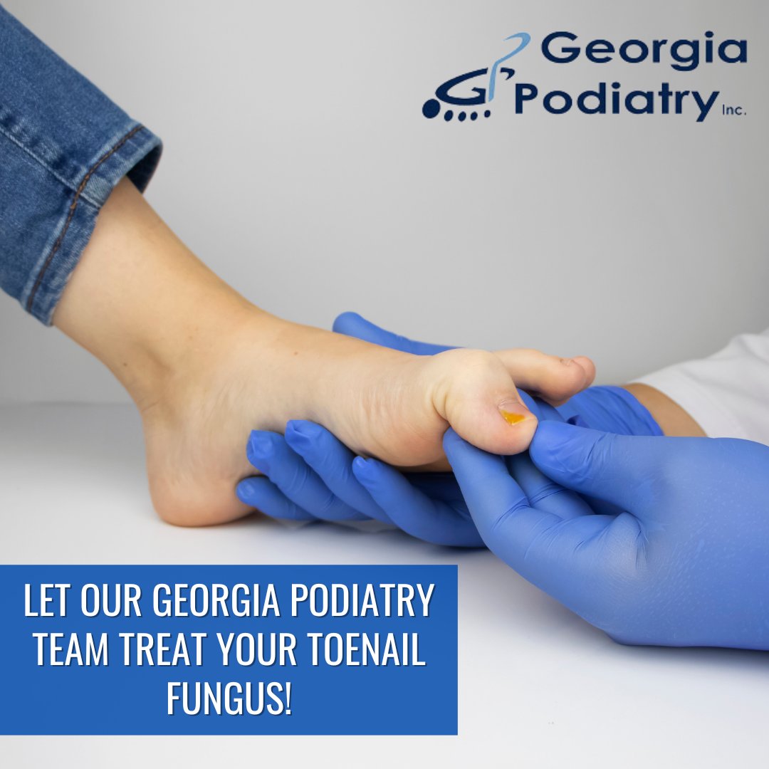 Gapodiatry's tweet photo. Beat toenail fungus this spring with the help of Georgia Podiatry! Visit our website below or give our office a call to learn more about your treatment options. https://t.co/PmWxRJftd9 https://t.co/vLZdgrXnsg