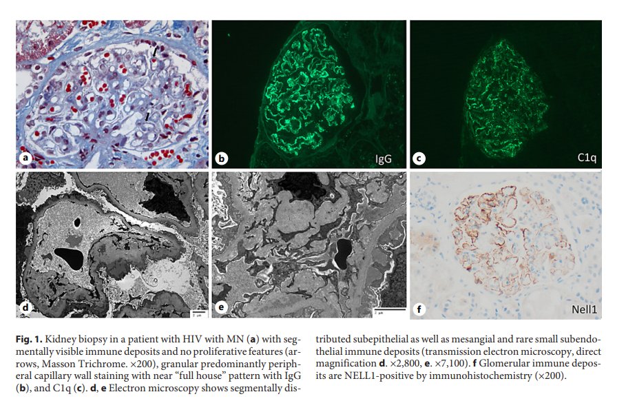 NephroKarger's tweet photo. NELL1-Positive #HIV-Associated Lupus-Like Membranous #Nephropathy with Spontaneous Remission
🔗 https://t.co/Ud02MDsPc6
✍ Dinesh K.P. et al.
📖 #GlomerularDis
#OpenAccess #NELL1 #MembranousPattern https://t.co/ZRaFdc8An4
