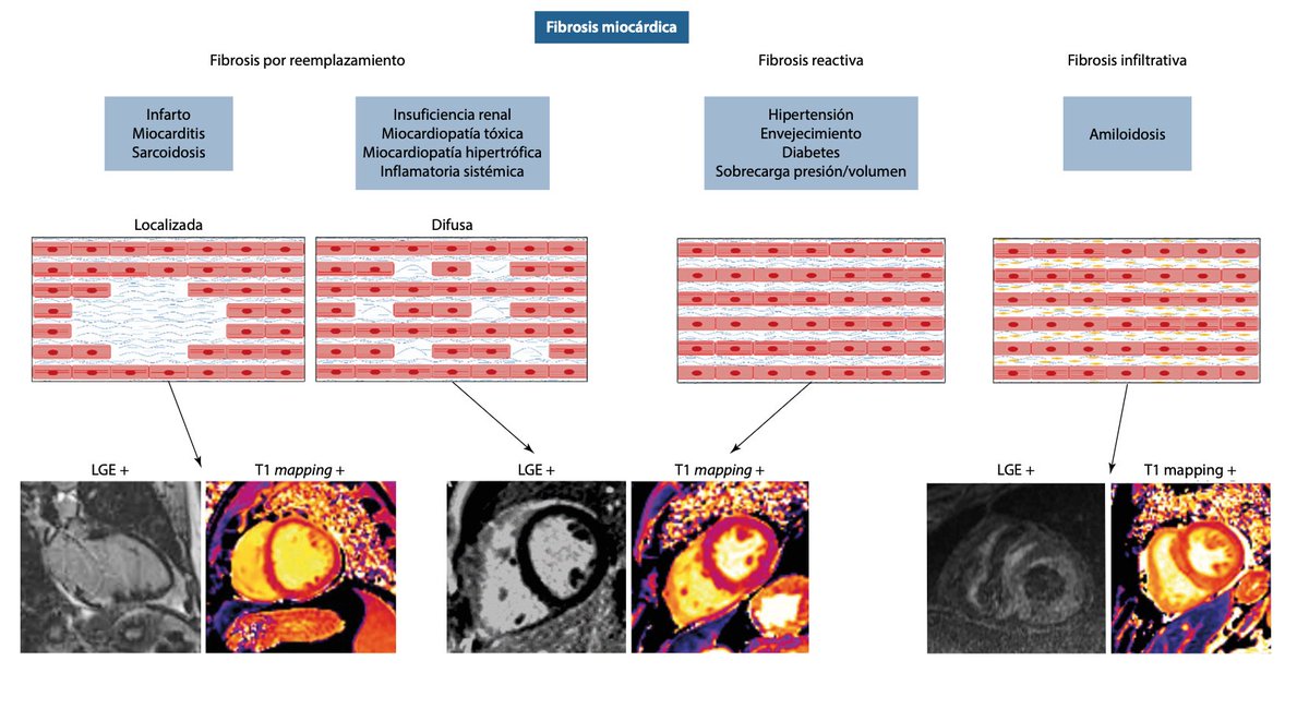 RevistaRetic (@revistaretic) on Twitter photo Excelente revisión.
"T1 mapping permite evaluar la fibrosis miocárdica microscópica difusa."
imagenretic.org/RevEcocarPract…
<a href="/almasthela/">Alma Sthela Arrioja, MD</a> <a href="/mariovar55/">Mario Vargas Galgani</a> <a href="/MAecocardio/">MA Garcia Fernandez</a> <a href="/josejgdnews/">Jose Juan Gomez</a> <a href="/Azcarate_Cardio/">Doctor Pedro Azcárate</a> <a href="/javierurmeneta1/">Javier Urmeneta</a> <a href="/rafavidalperez/">rafavidalperez</a> <a href="/CardioCecconi/">Alberto Cecconi</a> <a href="/chileanestesia/">Editora Revista Chilena de Anestesia</a> Excelente revisión.
"T1 mapping permite evaluar la fibrosis miocárdica microscópica difusa."
imagenretic.org/RevEcocarPract…
<a href="/almasthela/">Alma Sthela Arrioja, MD</a> <a href="/mariovar55/">Mario Vargas Galgani</a> <a href="/MAecocardio/">MA Garcia Fernandez</a> <a href="/josejgdnews/">Jose Juan Gomez</a> <a href="/Azcarate_Cardio/">Doctor Pedro Azcárate</a> <a href="/javierurmeneta1/">Javier Urmeneta</a> <a href="/rafavidalperez/">rafavidalperez</a> <a href="/CardioCecconi/">Alberto Cecconi</a> <a href="/chileanestesia/">Editora Revista Chilena de Anestesia</a>