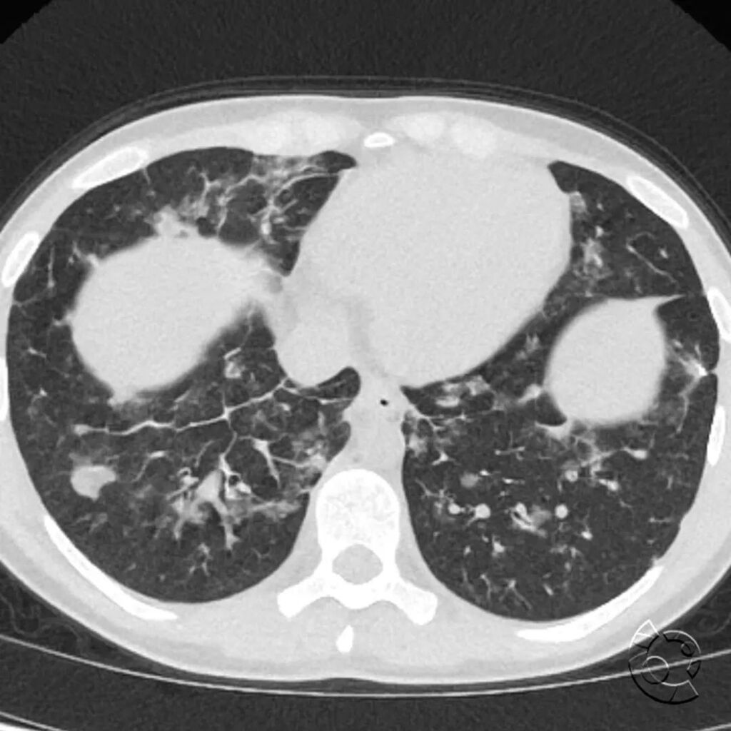 CincyKidsRad's tweet photo. Axial CT of the chest shows multiple pulmonary nodules, interstitial thickening worse in the right lower lobe. The patient was diagnosed with granulomatous and lymphocytic interstitial lung disease. What underlying disorder is associated granulomatous an… https://t.co/Q6QKZkUn1l https://t.co/1urBYLZQ9z