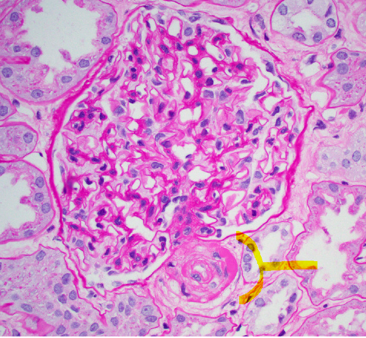 JZRenalPath's tweet photo. Time zero implantation biopsy with nodular medial hyalinosis  of an arteriole. Typically considered a sign of chronic CNI tox. But as illustrated, not always specific. #renalpath #PathTwitter https://t.co/7Iqi8jXkaZ