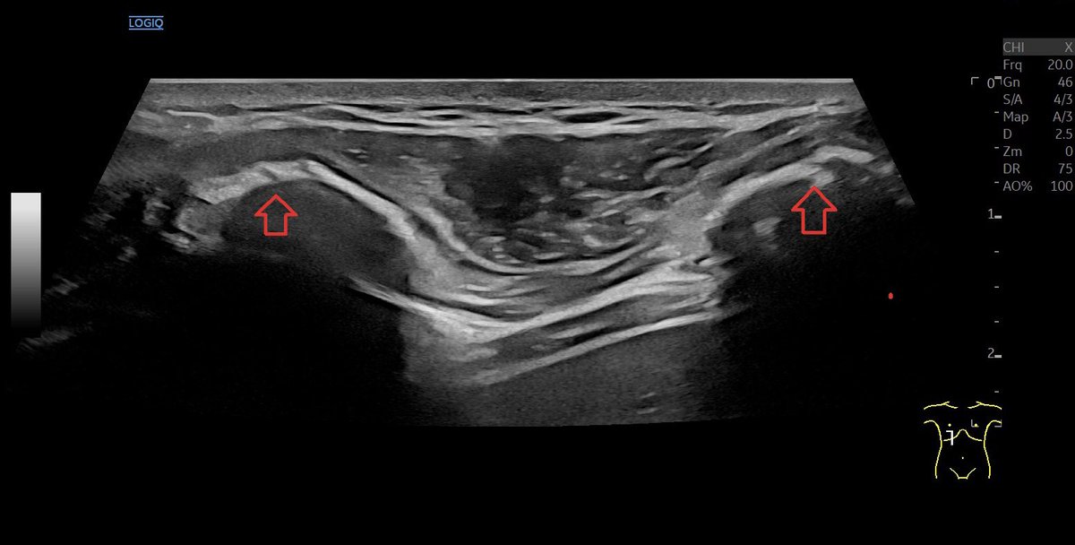 SportklinikBern's tweet photo. Rip fracture after 4 weeks in #mskus #pocus #pocushub #GElogiqE10r3 #ripfracture https://t.co/SobS6DR86B