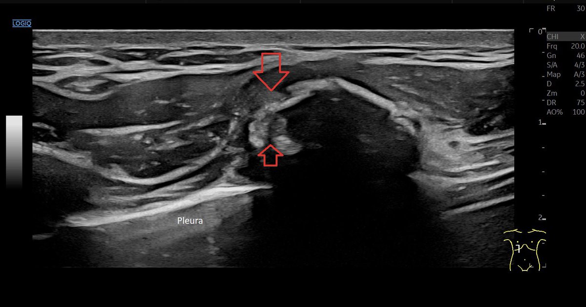 SportklinikBern's tweet photo. Rip fracture after 4 weeks in #mskus #pocus #pocushub #GElogiqE10r3 #ripfracture https://t.co/SobS6DR86B