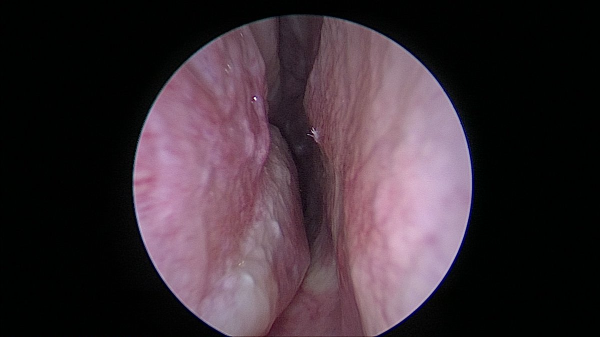 DrScottFortune's tweet photo. Office turbinate reduction with #microdebrider #TurbinateHypertrophy #NasalObstruction #OfficeBasedRhinology #MinimallyInvasiveRhinology https://t.co/eCxdDbj5wA