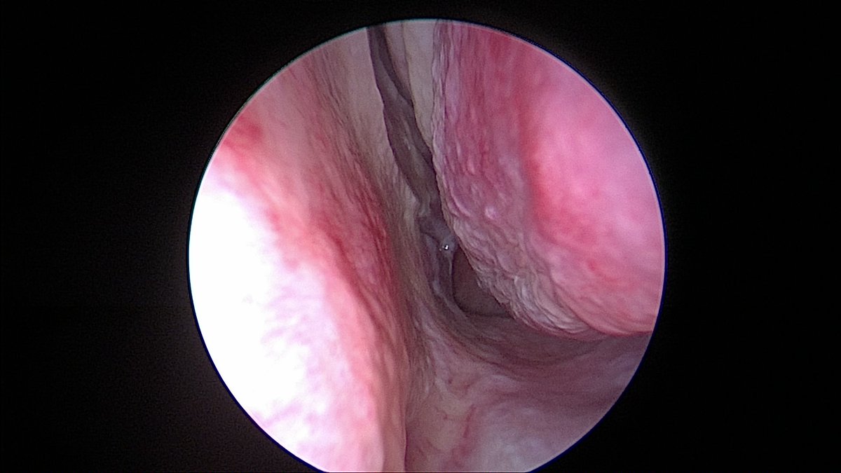 DrScottFortune's tweet photo. Office turbinate reduction with #microdebrider #TurbinateHypertrophy #NasalObstruction #OfficeBasedRhinology #MinimallyInvasiveRhinology https://t.co/eCxdDbj5wA