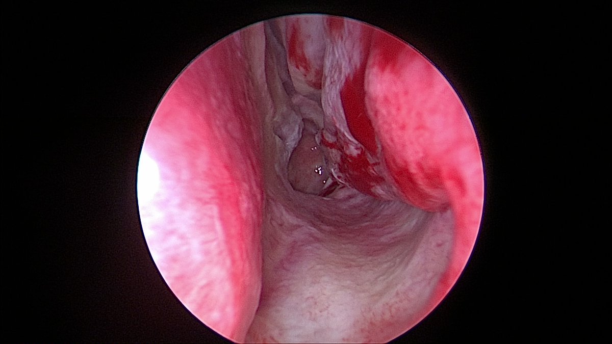 DrScottFortune's tweet photo. Office turbinate reduction with #microdebrider #TurbinateHypertrophy #NasalObstruction #OfficeBasedRhinology #MinimallyInvasiveRhinology https://t.co/eCxdDbj5wA