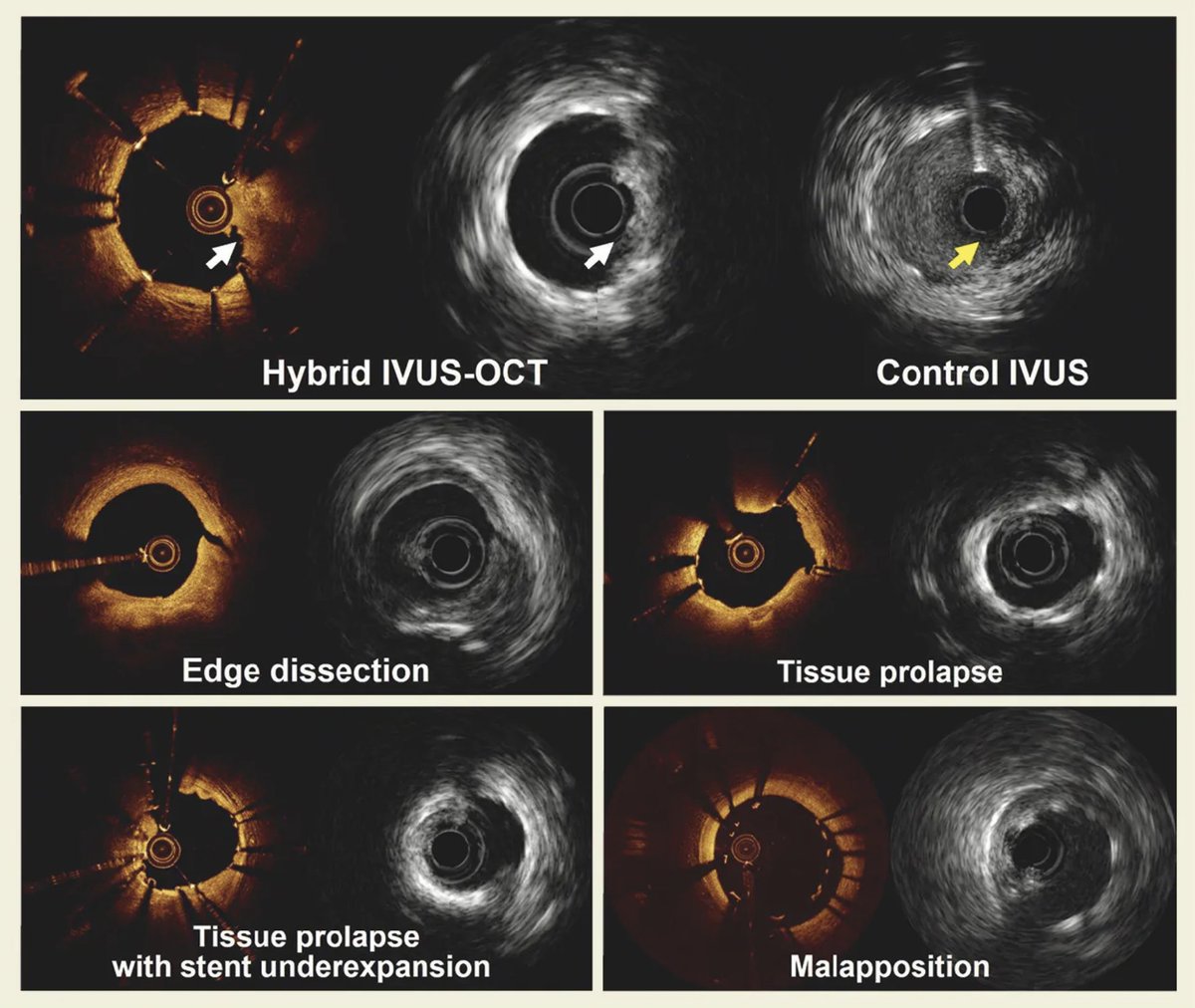 Davide Capodanno (@dfcapodanno) on Twitter photo Hybrid IVUS-OCT systems can overcome the limitations associated with each technology and integrate the advantages of both modalities. Recently, a novel hybrid imaging system (PANOVISION) was approved for clinical use and tested in this noniferiority trial. eurointervention.pcronline.com/article/clinic… Hybrid IVUS-OCT systems can overcome the limitations associated with each technology and integrate the advantages of both modalities. Recently, a novel hybrid imaging system (PANOVISION) was approved for clinical use and tested in this noniferiority trial. eurointervention.pcronline.com/article/clinic…