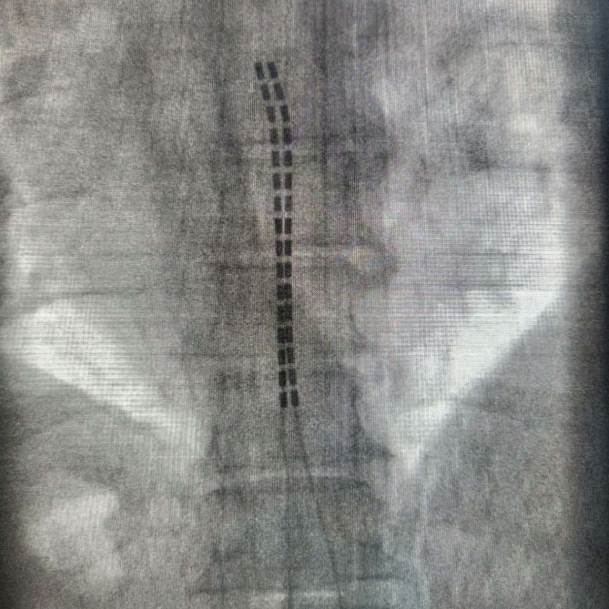 AGitkindMD's tweet photo. Great day teaching residents and fellows all about spinal cord stimulation with three trials done.  Awesome job Dr. @DevinOakes12, on all three!! Thank you @bostonsci and Jared Homan

@MontefiorePMR @MontefioreOrtho @MontefioreNYC @AAPMR
@AAPhysiatrists #spine #scs https://t.co/BKyHHkcwHN