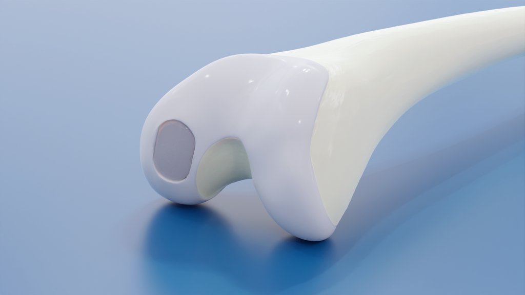 BioPoly® Announces FDA Breakthrough Device Designation of the BioPoly Knee System

Read more here: biopolyortho.com/news/biopoly-a…