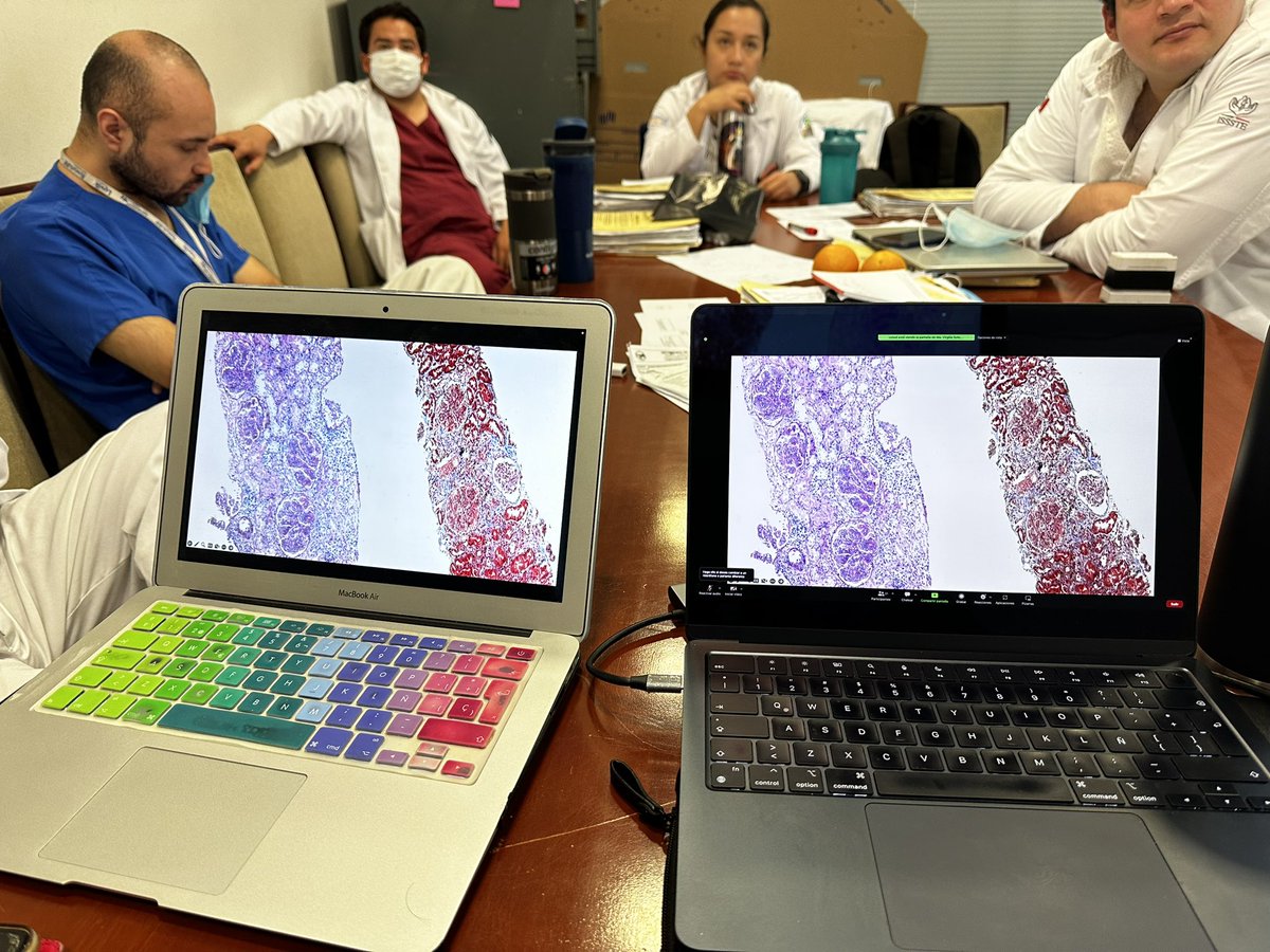 Nephro_Ivan's tweet image. Sesión de nefropatología con residentes de nefrología de @nefrologia_HJM del @HospitalJuarezM y de @NefroHC de @HCentralSLP . Caso muy interesante de GNRP por Lupus Like por HIVICK. 
#Nephropath
 #KidneyDisease 
#kidneybiopsy