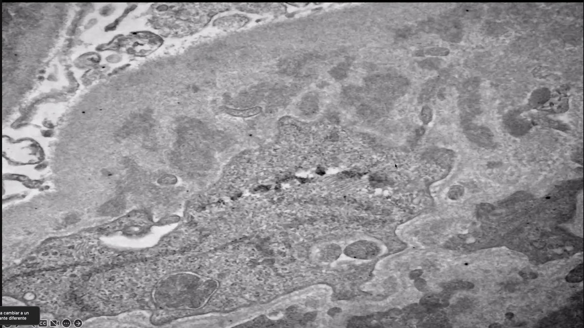 Nephro_Ivan's tweet image. Sesión de nefropatología con residentes de nefrología de @nefrologia_HJM del @HospitalJuarezM y de @NefroHC de @HCentralSLP . Caso muy interesante de GNRP por Lupus Like por HIVICK. 
#Nephropath
 #KidneyDisease 
#kidneybiopsy