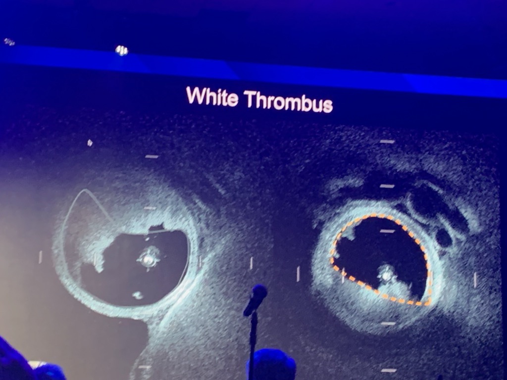 It is a historic day in the Cerebrovascular world!

At @WLNCofficial, we presented the first in man cases of neuro HFOCT - and it surpassed all our expectations!!!
