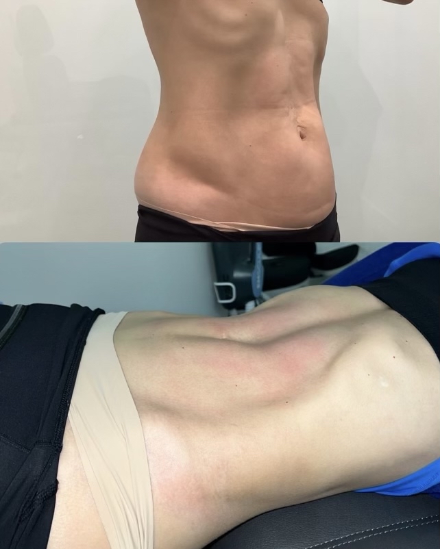 PUREHealthMiami's tweet photo. #results Friday of a Mother that is an avid runner and has 4 kids. We can help you attain your goals. Whether it’s losing weight, toning up, or gaining strength, we can help with our medical providers.  

 ⭐️ Equivalent to 20,000 sit ups (or reps)  per session
⭐️ Burns 30% fat (e https://t.co/mWcF90oXuZ
