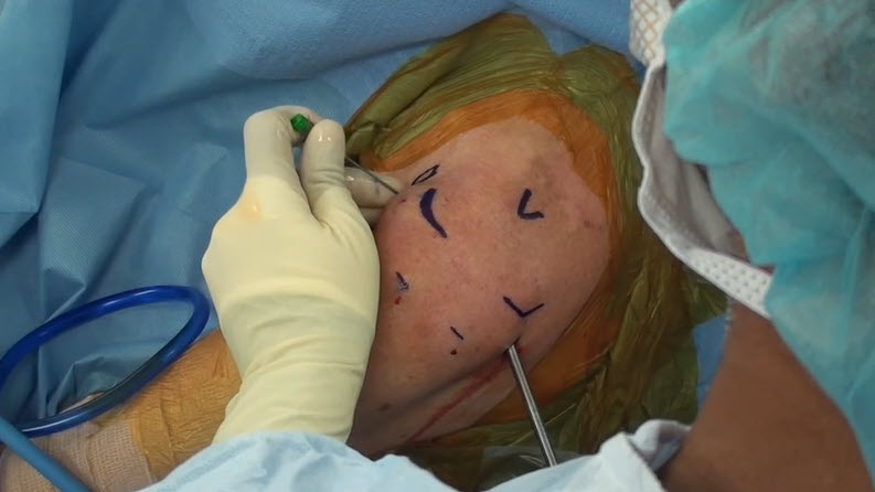 AAOS1's tweet photo. Watch an #Arthroscopic interstitial #RotatorCuff repair with #BubbleSign on #OVT:
https://t.co/3sVTalHBNv

Log in and share your #technique!

#OrthoTwitter
#MedTwitter
#OVTFridays
#OrthoResidency
#Surgeon
@drchrisahmad
@DavidTrofaMD
@OrthoColumbia
@JSonnenfeldMD
@columbiamed https://t.co/jfxprJw4DJ
