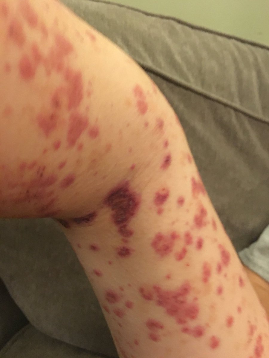 o_ello's tweet photo. @drkeithsiau Got a nice pic of this. Son said to me on day 4, mom I really think you need to look at this rash I have 😳😳😳#baddoctor https://t.co/fGKH4Nn27e