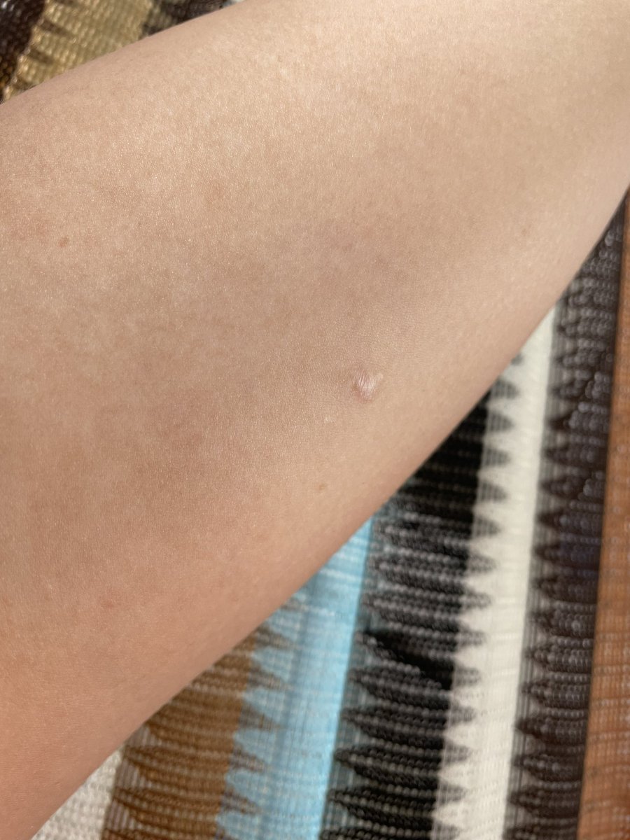 AleeCastaeda1's tweet photo. 4 meses usando el JADELLE, 30 libras de más, tarde 1 año después de eso para poder embarazarme… nunca en la vida lo usen en mi caso fue lo peor 🥺 https://t.co/tLiwxPPCSO