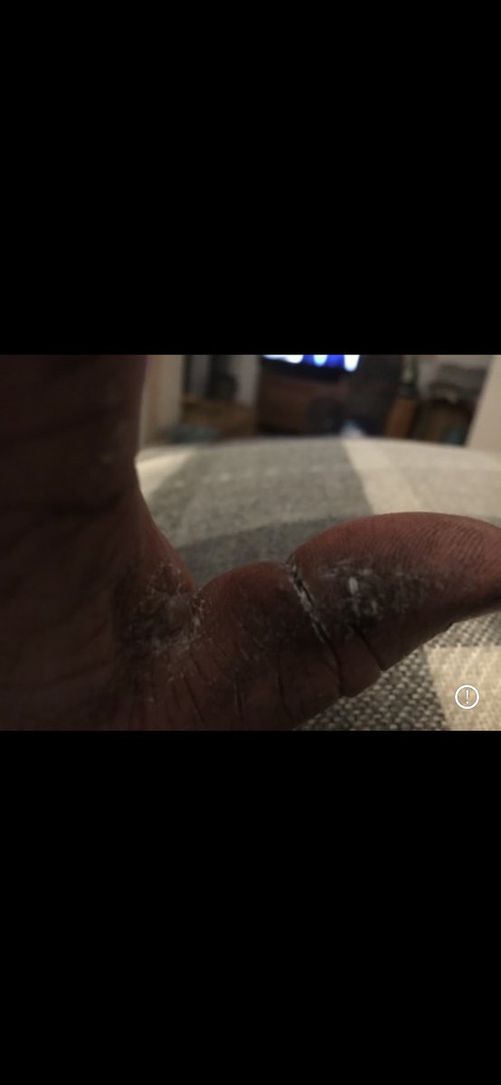 ben_hankey's tweet photo. @1GarethWynJones Mine split in winter aswell mate , I put that working hands crème on its in a little green pot , find it helps no end , it’s the thumbs splits that are a 🤬 comes with the job though doesn’t it 🙄 https://t.co/evL4RPvU9s