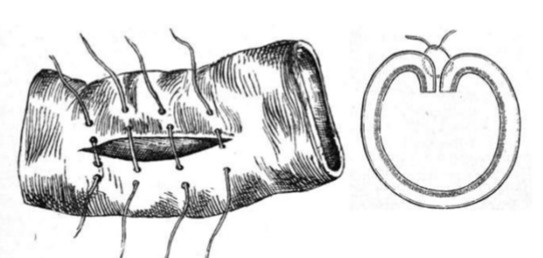 PipeCabreraV's tweet photo. Surgeons in history: Antoine Lembert studied under Guillaume Dupuytren in Paris, where he was epidemiologist to the Seine-Département. In 1828 he won a prize from the Académie des sciences for his Essai sur la méthode endermique. He is remembered for the intestine suture! https://t.co/fGWkCS35x3
