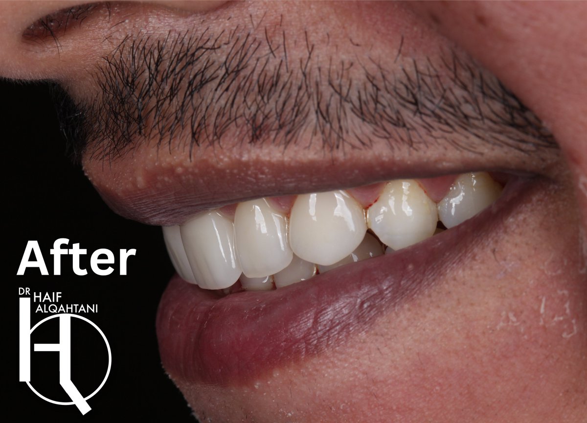 HaifALQahtani's tweet photo. 2 Crown and 4 Veneers وجهزنا ابتسامة معرسنا 😎🤝 إستبدال للحشوات القديمه واصلاح البروز ب ٦ تلبيسات فقط https://t.co/p6i47BZpXG