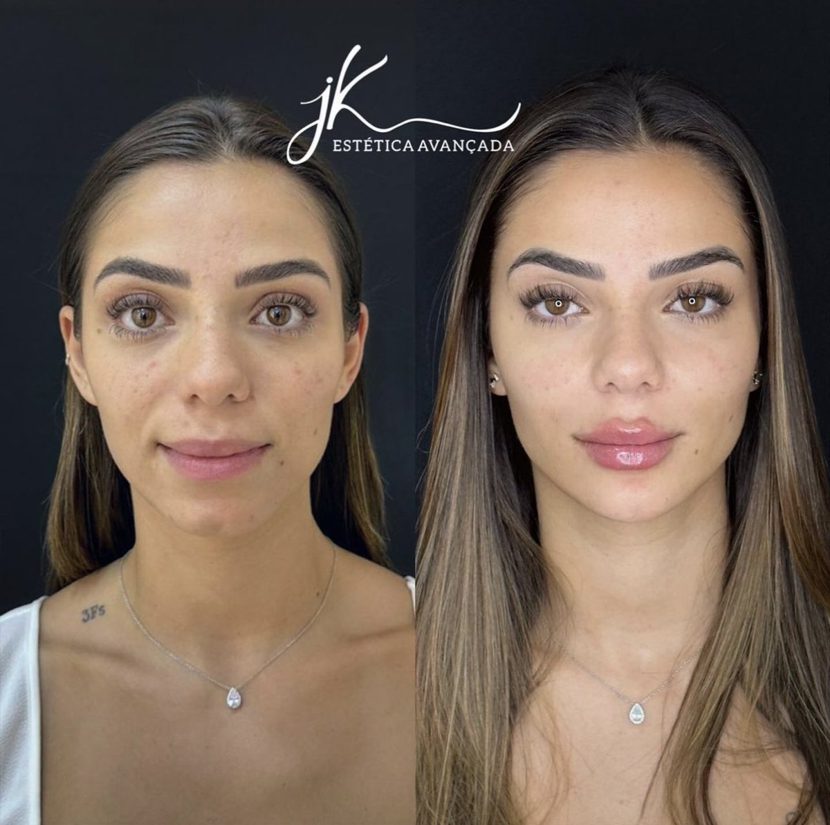 choquei's tweet photo. 🚨FAMOSOS: Keyt Alves, irmã de Key Alves, realizou uma harmonização facial. https://t.co/E2fvxEx4EV