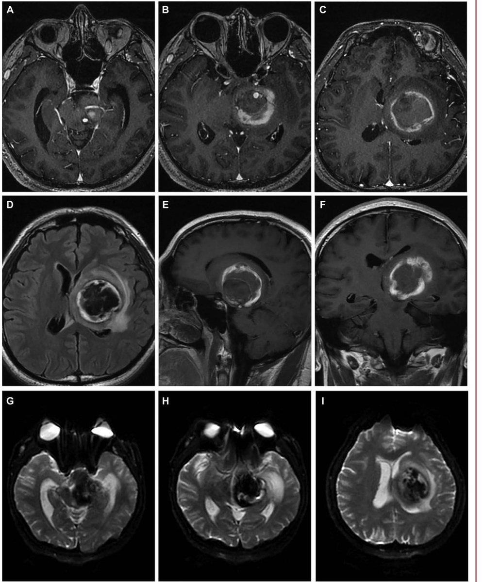 Fauxvector's tweet photo. Pre-op imaging… #cavernousmalformation #dsistudio https://t.co/bQq289RvDy