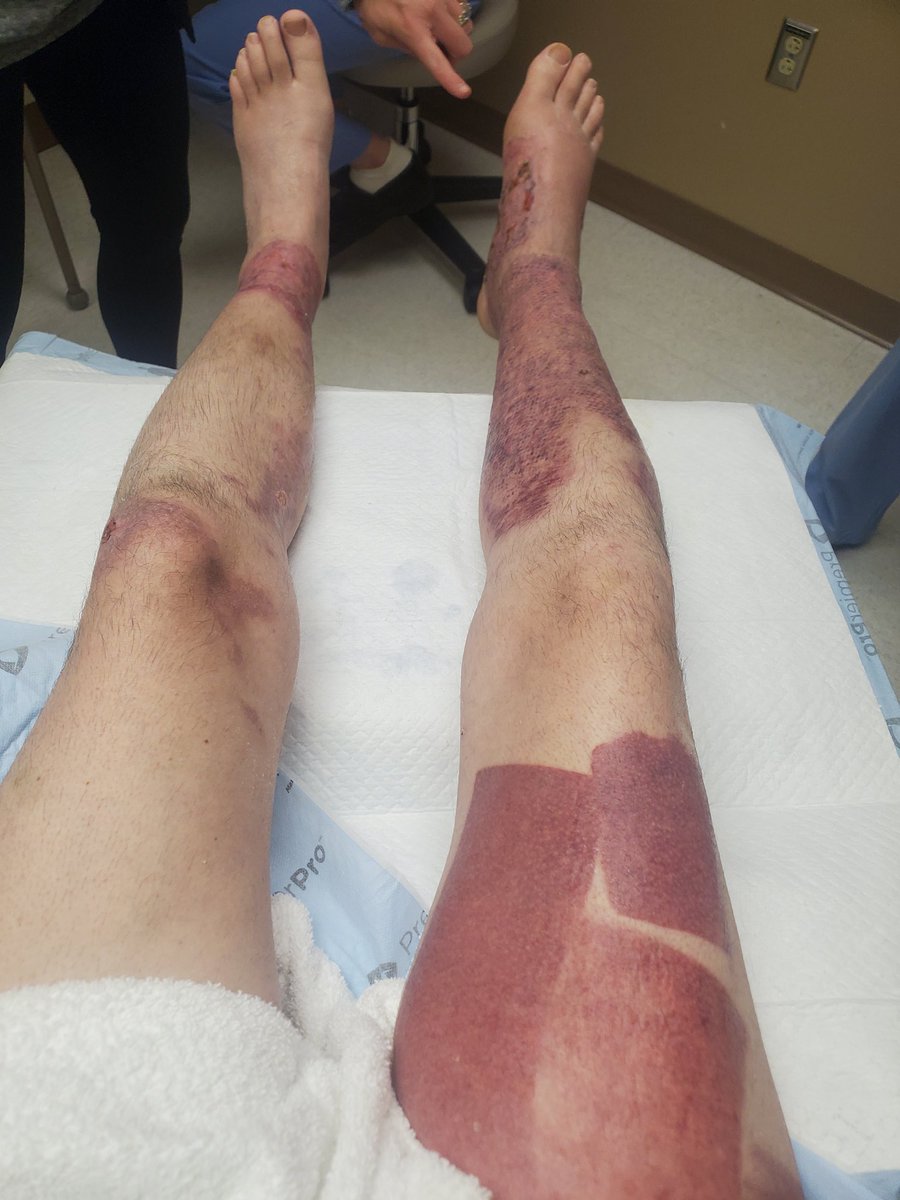 Today's Dr appointment went great!  No more surgeries at this time and can move on to pt.  I know people have been curious and wounds are looking good so attached is a current pic.   My thigh is the donor sight from grafts.  I appreciate everyone's kindness and prayers.