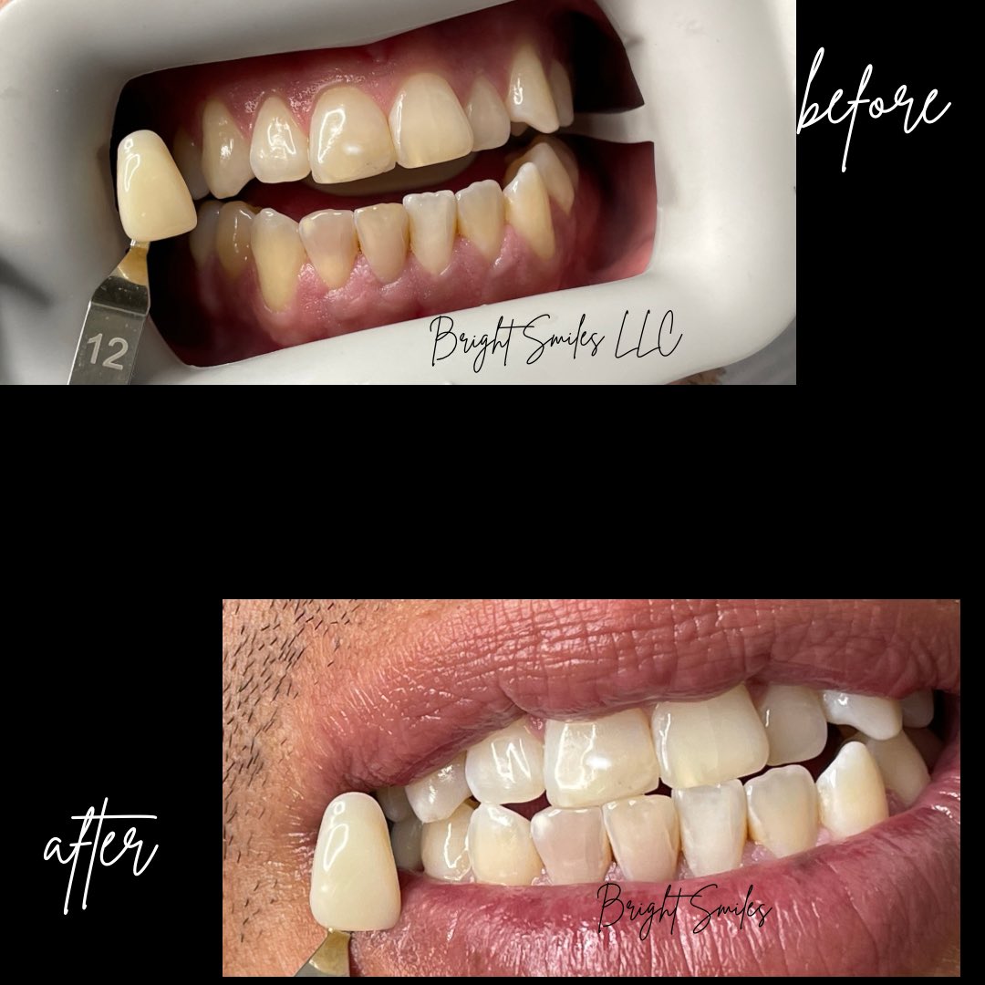 chacez1998's tweet photo. You a smoker ? Yes you can definitely whiten your teeth ! #denverteethwhitening #denverbusiness https://t.co/jkk9rC6hxj