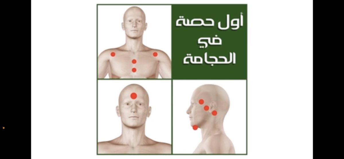 manksa87's tweet photo. اول حصة في الحجامة لمرضي الاسحار تكون حجامة الوجه و ع الاذنين والصدر 
الاسحار تتمركز في الناصية وهي مركز التحكم في العقل والدماغ والعقل الباطن
الشياطين تعمل اجهزة وراء الاذن
وهذي الحجامه ممتازه لاسحار تشويه الجمال والتي تتمركز في الوجه وايضا لاسحار الفواحش والتي تتمركز في العينين https://t.co/yo365Gtgh3