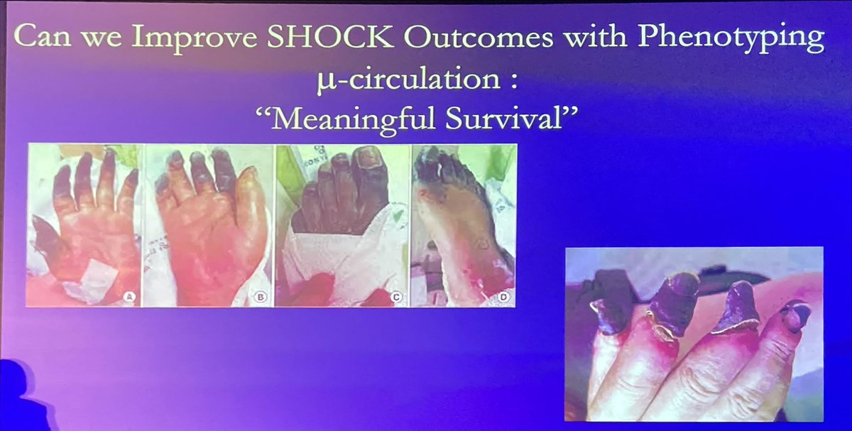<a href="/ThomasMDas/">Tommy Das, MD</a> <a href="/CardioNerds/">CardioNerds</a> <a href="/AmitGoyalMD/">Amit Goyal MD MAS</a> <a href="/KatieV_MD/">Katie V</a> <a href="/jeffrey_wang24/">Jeffrey Wang</a> Agree - under appreciated topic. Salvaging the macrohemodynamic situation is the first step, but the toll our therapy takes on the microcirculation can’t be ignored.