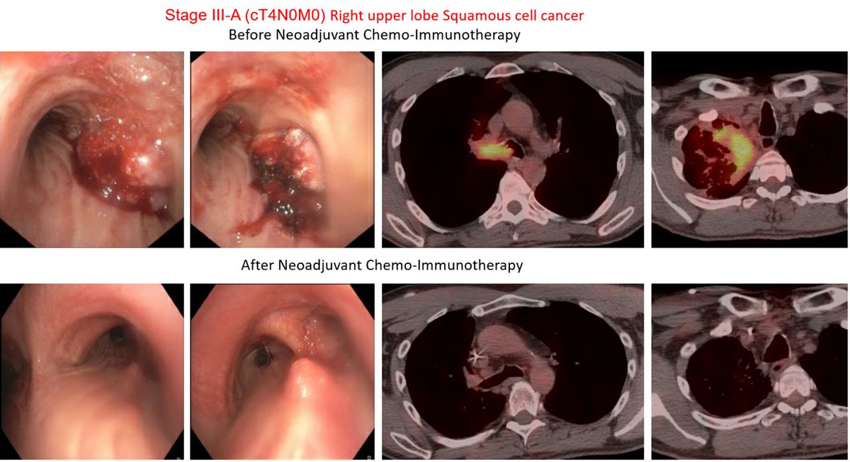 I saw a patient with complete occlusion of R mainstem with squam Ca. What would have required a carinal pneumonectomy ended up getting a sleeve resection only. Immunotherapy is GAME CHANGER!!