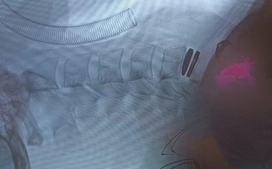 🧠 Como #Neurocirujano, estoy emocionado de compartir información sobre la Artroplastia de Columna Cervical, ¡un procedimiento innovador que transforma el cuidado de la columna vertebral! 💡🔬 Analicemos los pros y contras de esta opción de tratamiento. 🌟 #SaludColumna
👍