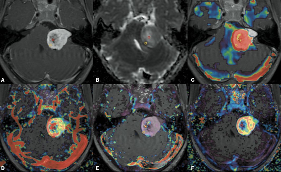 ConstanzoMD's tweet photo. 2.Both size and cystic status influence perfusion values (Ktrans and Ve), therefore, using PWI should not be used for DDx w/o accounting for these features, questioning previous results. https://t.co/pAFZGMEVKa