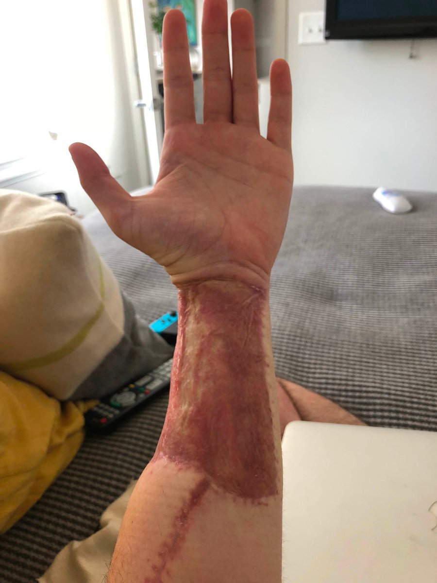Jacksun0's tweet photo. @PunksTwin @UNMEDICATEDADIL I wouldn’t think that I- pumping loads of medicine into my body, getting a gender reassignment is going to make me a happy, healthier person. Does this look healthy to you? Would you be happy to do this to yourself? That’s kinda how fake penises are made.. right? https://t.co/UEc3HhL95w