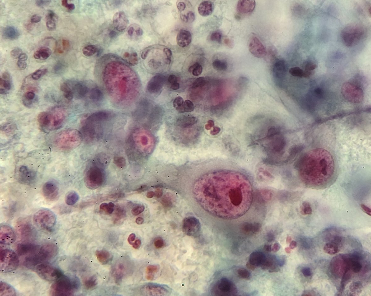 PSzwebel's tweet photo. 32 y/o first Papanicolaou.
SCC Convencional Pap Smear https://t.co/fbzspvKZ94