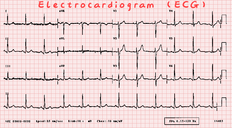 faizmashood's tweet photo. Dalam perubatan,

HEART ATTACK dikenali sebagai ACUTE CORONARY SYNDROME 🫀

Untuk diagnosis, memerlukan:
1️⃣simptom
2️⃣ujian darah: cardiac enzyme
3️⃣ECG

Rawatan segera: 
✅Ubat cair darah
✅ Ubat jantung + kolesterol

Rawatan muktamad:
✅Coronary angiogram https://t.co/a0nrzUs4uK