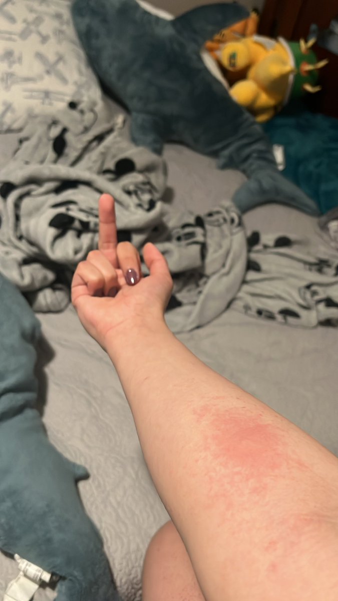 Crazydog1435 on Twitter: "A wasp just stung me"