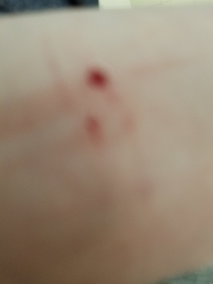 emodeath88's tweet photo. Ooops, hit a doornob again! https://t.co/jgIO2OwqnV