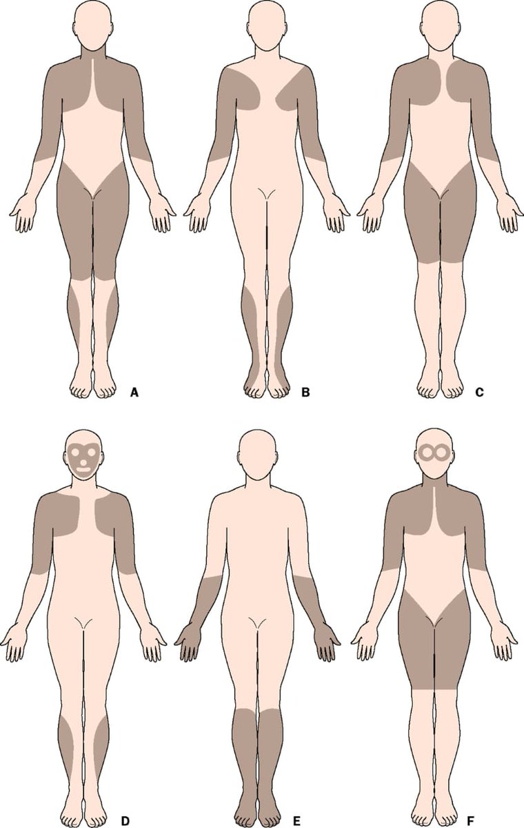 Clinically defined types of "muscular dystrophy" based on distribution of predominant muscle weakness

A- Duchenne-type and Becker-type
B- Emery-Dreifuss
C- Limb-girdle
D- Facioscapulohumeral
E- Distal
F- Oculopharyngeal

#physiolair #physiotherapy #physicaltherapy #فيزيو