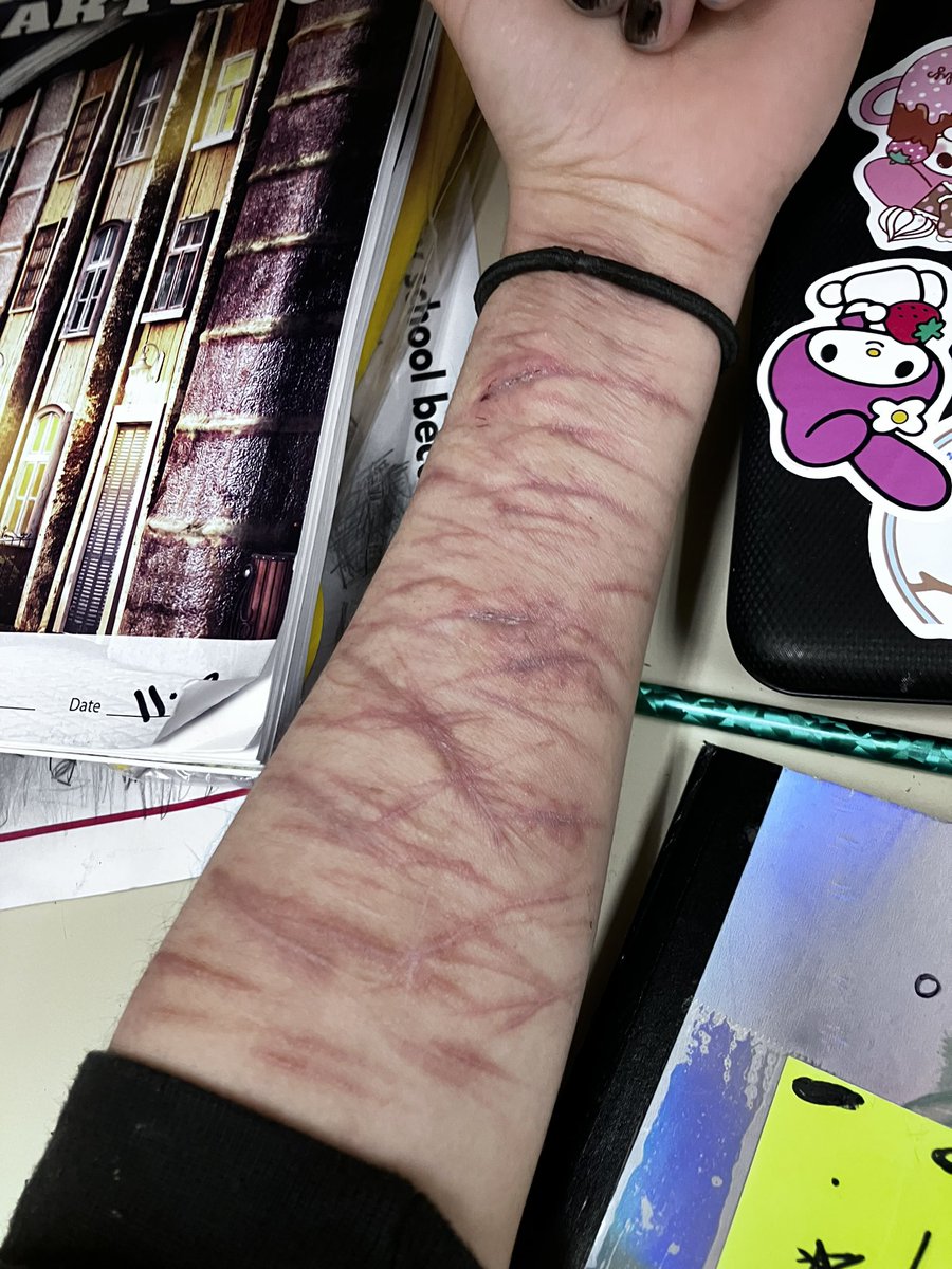 leaffff0's tweet photo. these scars are from 2/3 months ago https://t.co/URbHqyzK5R
