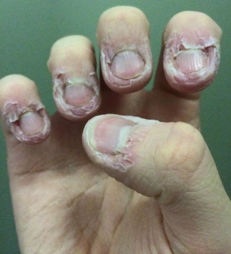 Por qué no puedo dejar de morderme las uñas